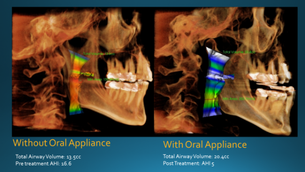 Airway X-Ray with Oral Appliance