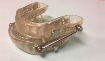 Example of Oral Appliance